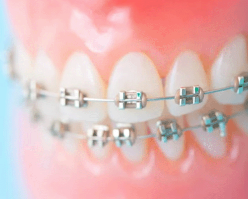 矯正歯科(保険外治療)